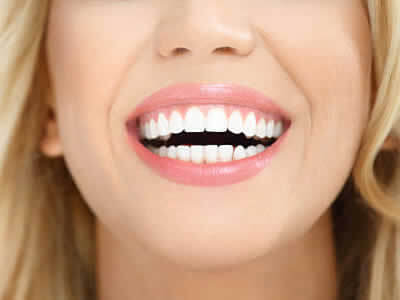 Hollywood Smile